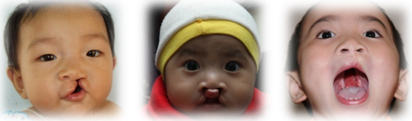 Khe hở môi - vòm là dị tật bẩm sinh khiến trẻ em gặp nhiều khó khăn trong cuộc sống