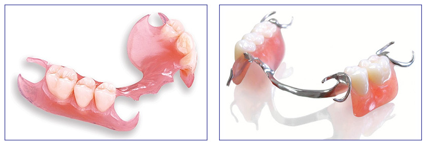 Hàm giả tháo lắp