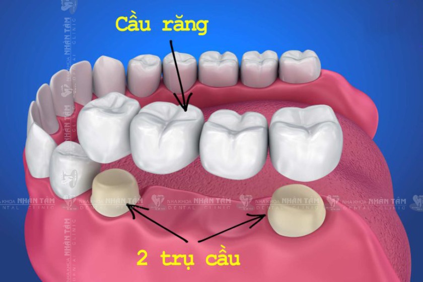 Cầu răng sứ