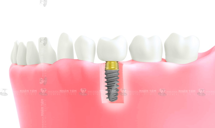 Trồng răng Implant