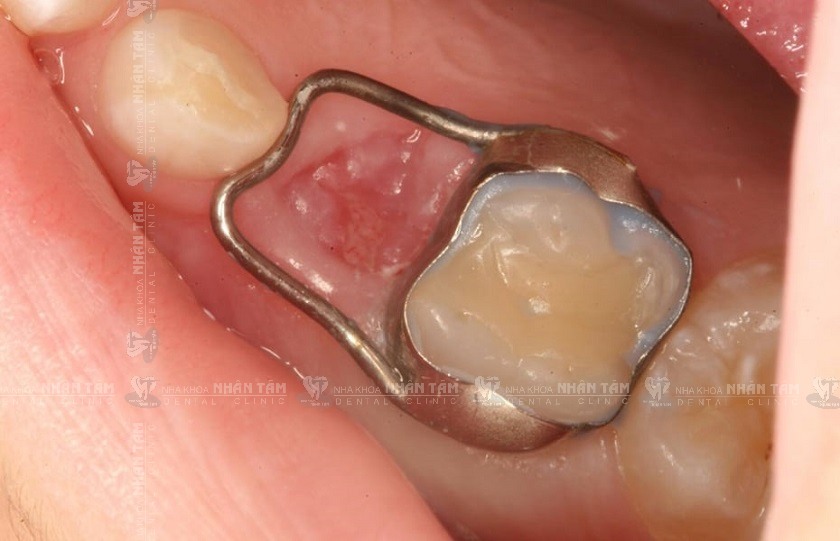 Hàm giữ khoảng được sử dụng trong trường hợp trẻ bị mất răng