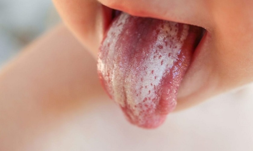 Bệnh nấm miệng cũng là nguyên nhân khiến nướu bị sưng viêm