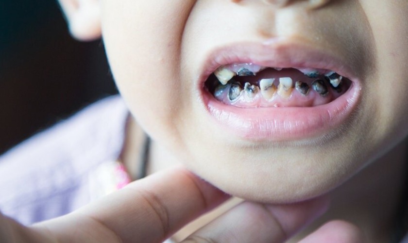 Sâu răng sẽ khiến trẻ bị ê buốt răng