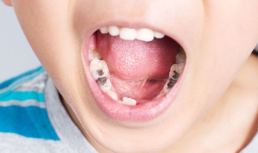 Giá hàn răng trẻ em phụ thuộc vào nhiều yếu tố Giá hàn răng trẻ em phụ thuộc vào nhiều yếu tố