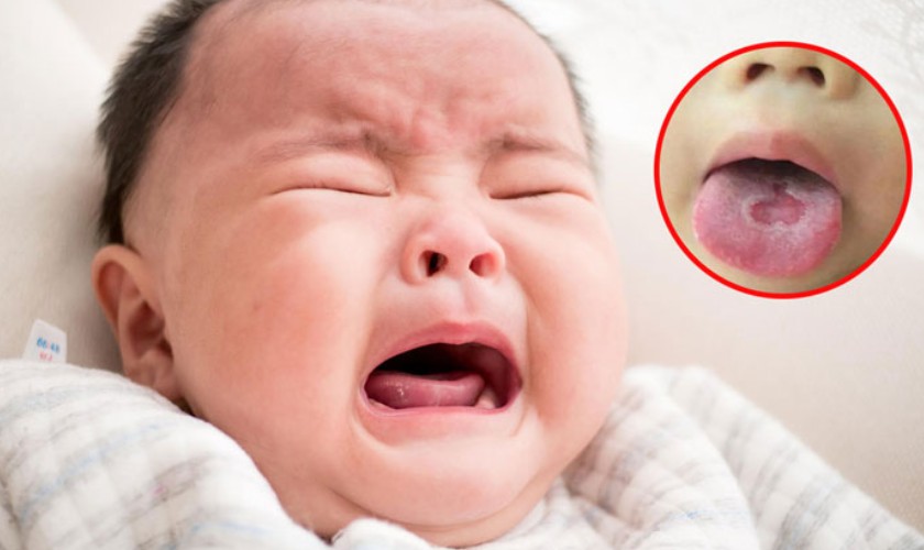 Từ hình ảnh tưa lưỡi, nhận biết sớm triệu chứng để điều trị