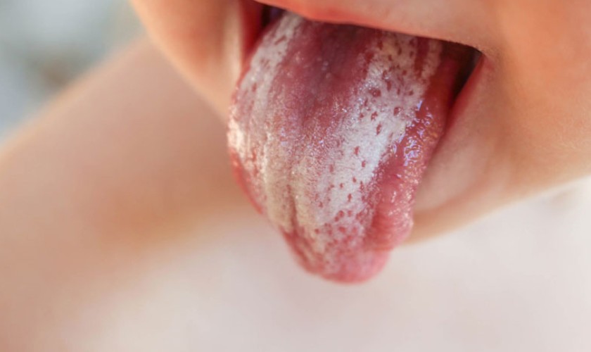 Bệnh tưa lưỡi thường xảy ra ở trẻ sơ sinh và trẻ nhỏ