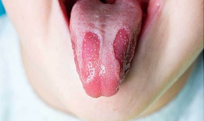 Dấu hiệu trẻ bị tưa lưỡi