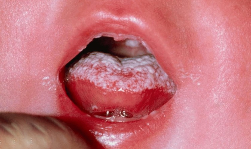 Bệnh tưa lưỡi có thể chuyển biến nghiêm trọng hơn
