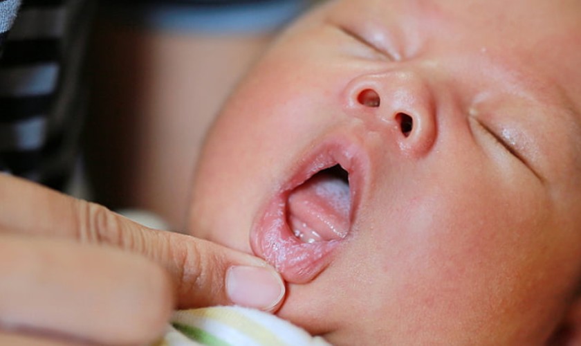 Lưỡi của bé có nhiều chấm trắng nhỏ