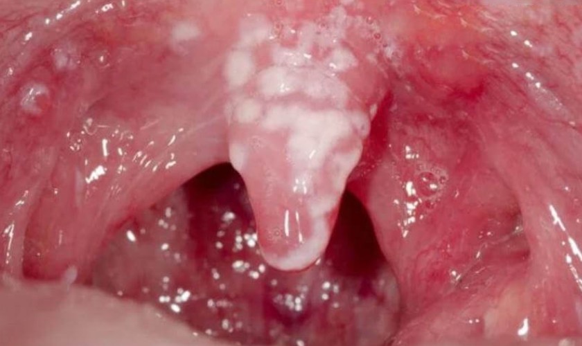 Những mảng bám trắng xuất hiện dày đặc