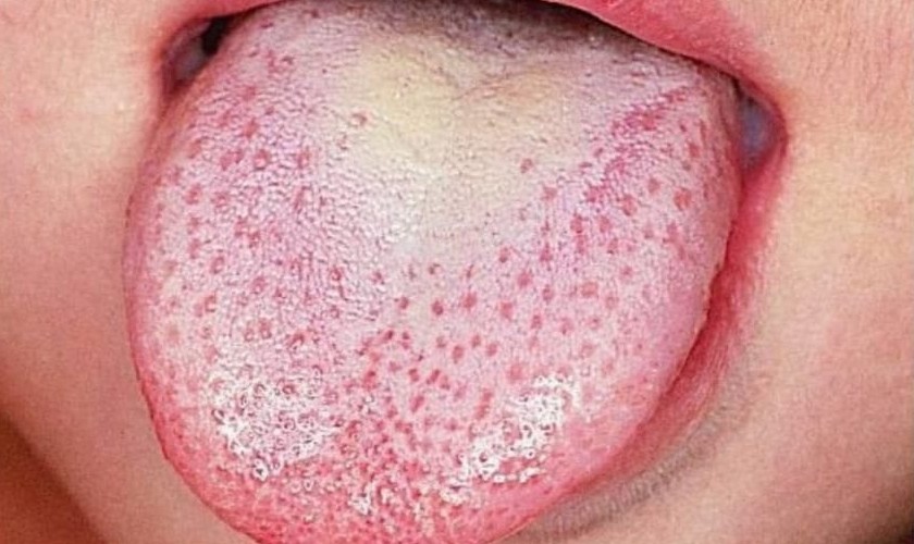 Các đốm trắng lan ra khắp lưỡi
