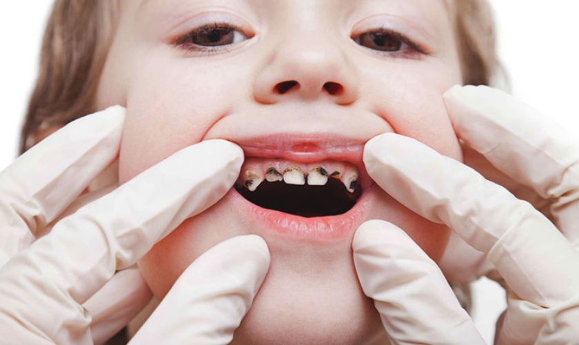 Độ tuổi nào là độ tuổi nhạy cảm nhất với sâu răng ở trẻ em?
