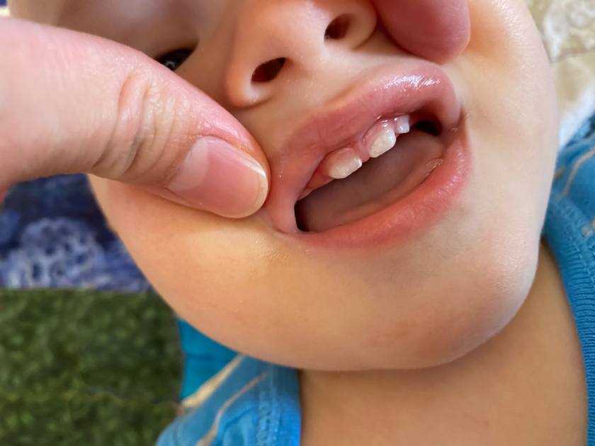 Răng bé có màu trắng đục có thể do di truyền từ ba mẹ