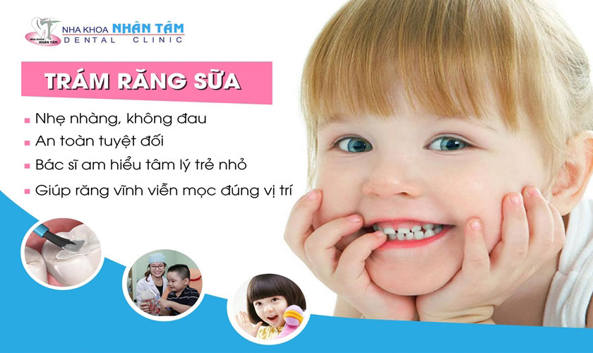 Răng bị sâu cần được trám để đảm bảo thẩm mỹ và khôi phục ăn nhai hiệu quả