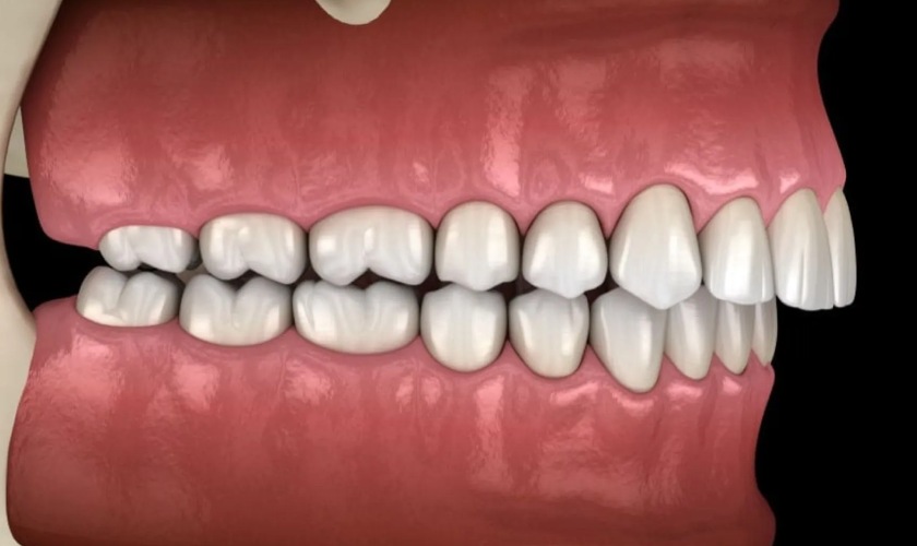 Khớp ngắn ngược - móm