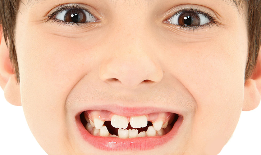 Tình trạng chậm mọc răng kéo dài có thể khiến răng vĩnh viễn của bé bị mọc lệch