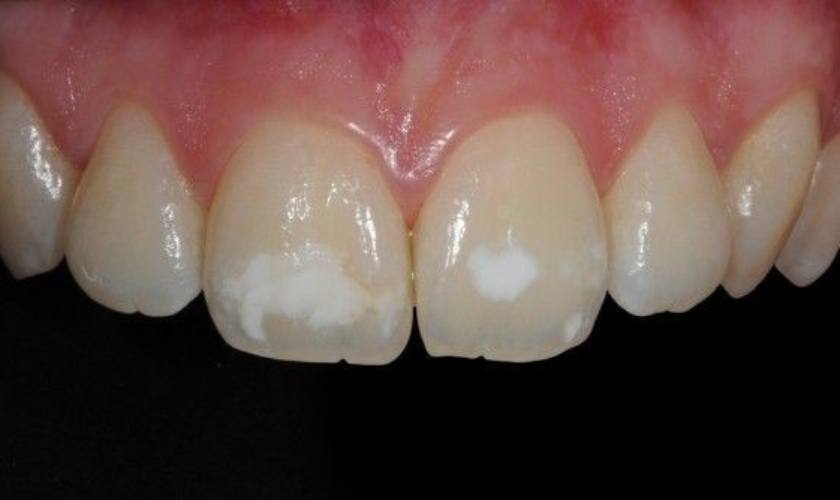 Răng trẻ em có đốm trắng là bị gì?