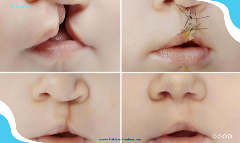 Điều trị sứt môi và hở hàm ếch ở trẻ