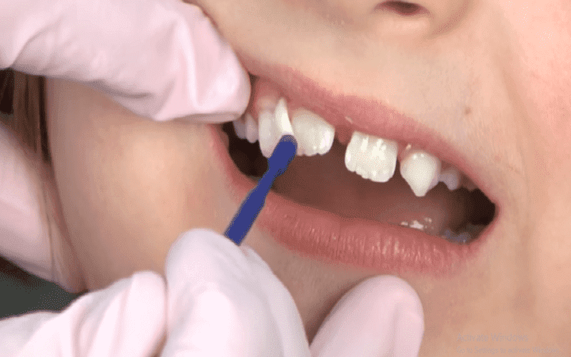 Tác động của sâu răng đến sức khỏe của trẻ 1 tuổi?
