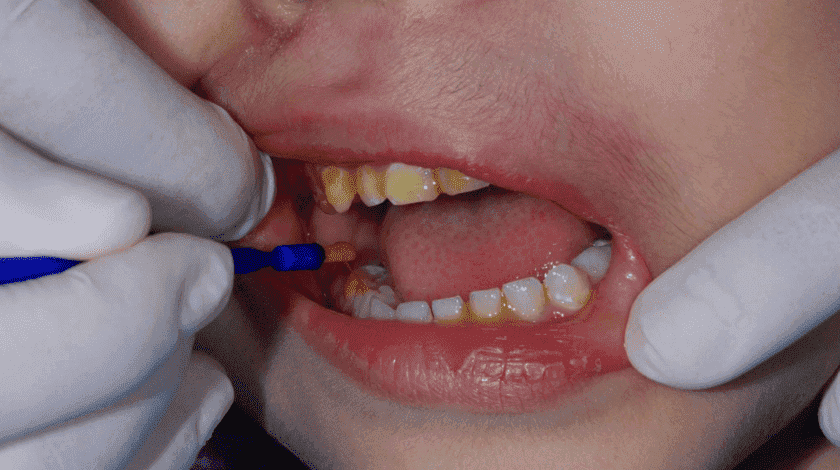 Thuốc bôi sâu răng cho trẻ em được sử dụng rộng rãi