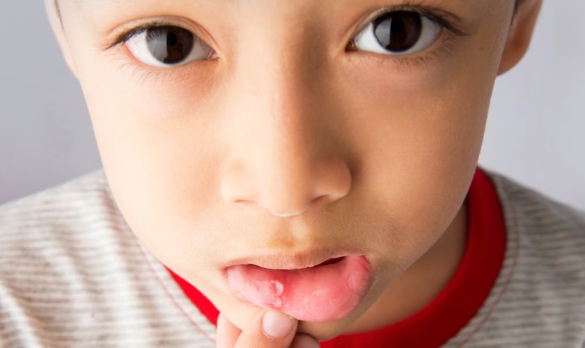 Top 10 loại thuốc nhiệt miệng cho trẻ em hiệu quả, an toàn