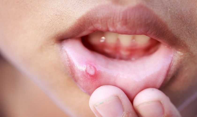 Dấu hiệu nhiệt miệng ở trẻ em