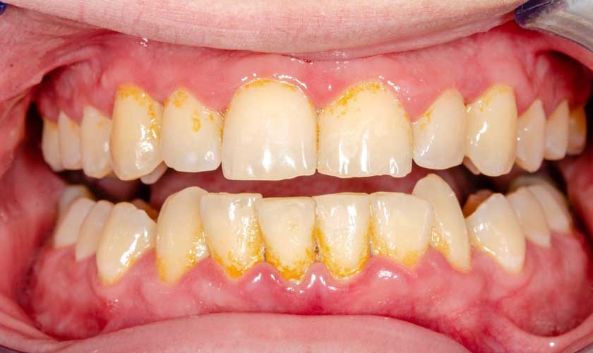 Vôi răng là nguyên nhân hàng đầu gây sâu răng, viêm nướu… ở trẻ