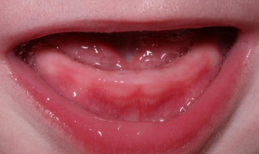 Nướu sưng đỏ là biểu hiện răng của trẻ sắp mọc