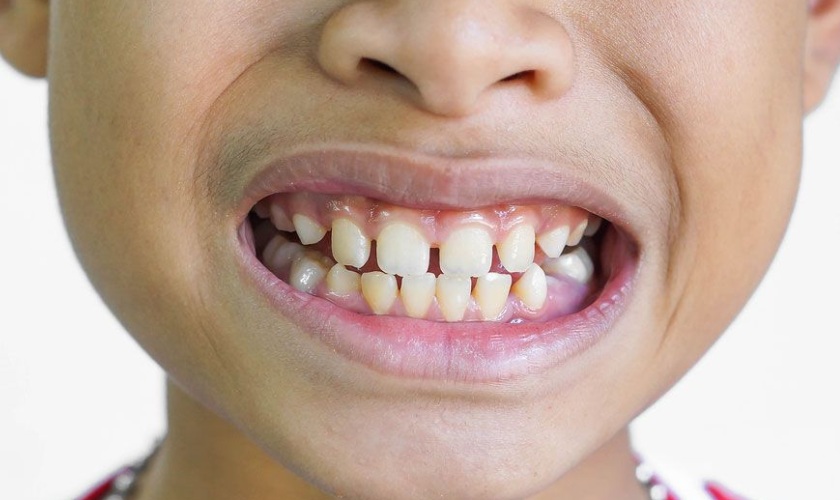 Trẻ em răng thưa do nhiều nguyên nhân gây nên Trẻ em răng thưa do nhiều nguyên nhân gây nên