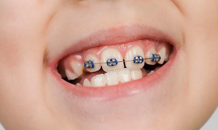 Niềng răng là giải pháp giúp khắc phục tình trạng răng thưa ở trẻ em hiệu quả Niềng răng là giải pháp giúp khắc phục tình trạng răng thưa ở trẻ em hiệu quả