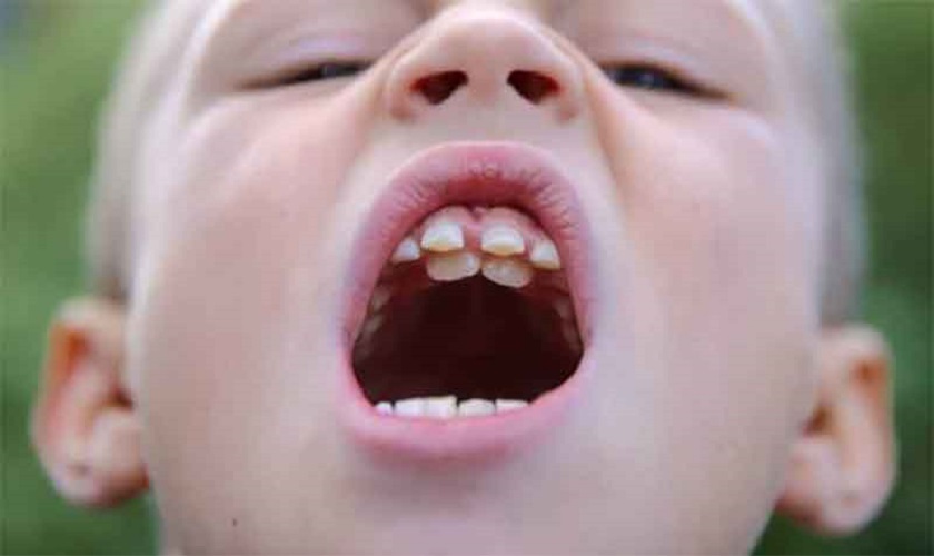 Hiện tượng “hàm răng đôi” do việc mọc và rụng răng sữa không đúng thời điểm