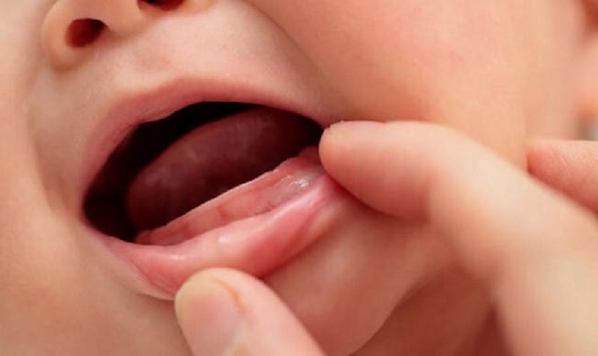 Trẻ mọc răng muộn là do đâu? Có sao không? Nên xử lý thế nào?