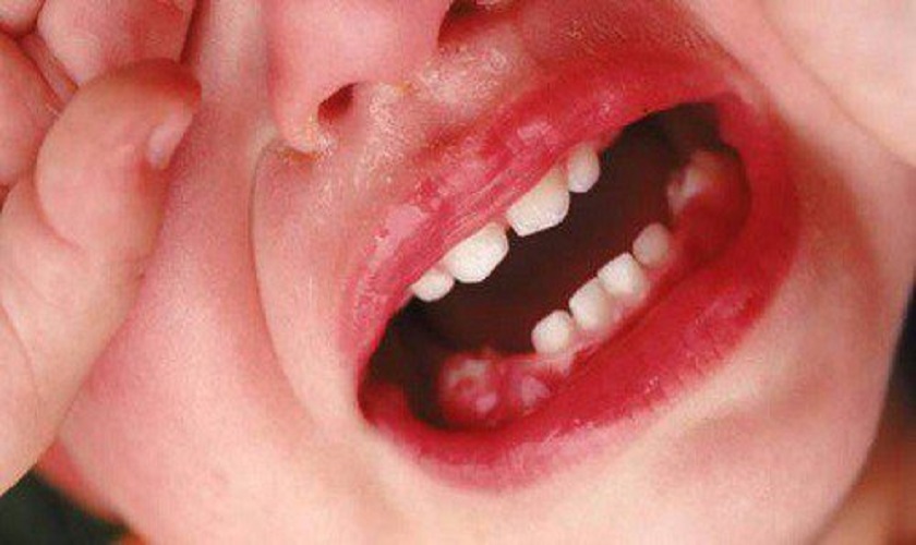 Mọc răng cấm ở trẻ nhưng không gây đau nhức, có bình thường không?