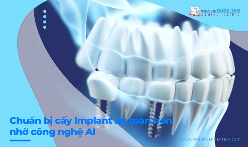 Chuẩn bị cấy Implant an toàn hơn nhờ công nghệ AI