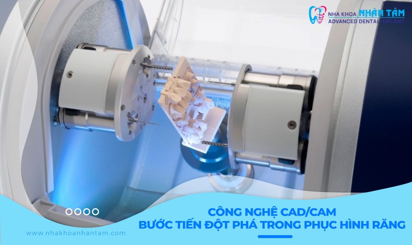 Công nghệ CAD/CAM – Bước tiến đột phá trong phục hình răng