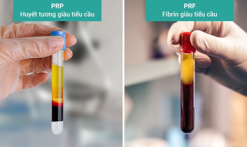 So sánh công nghệ màng PRF và PRP