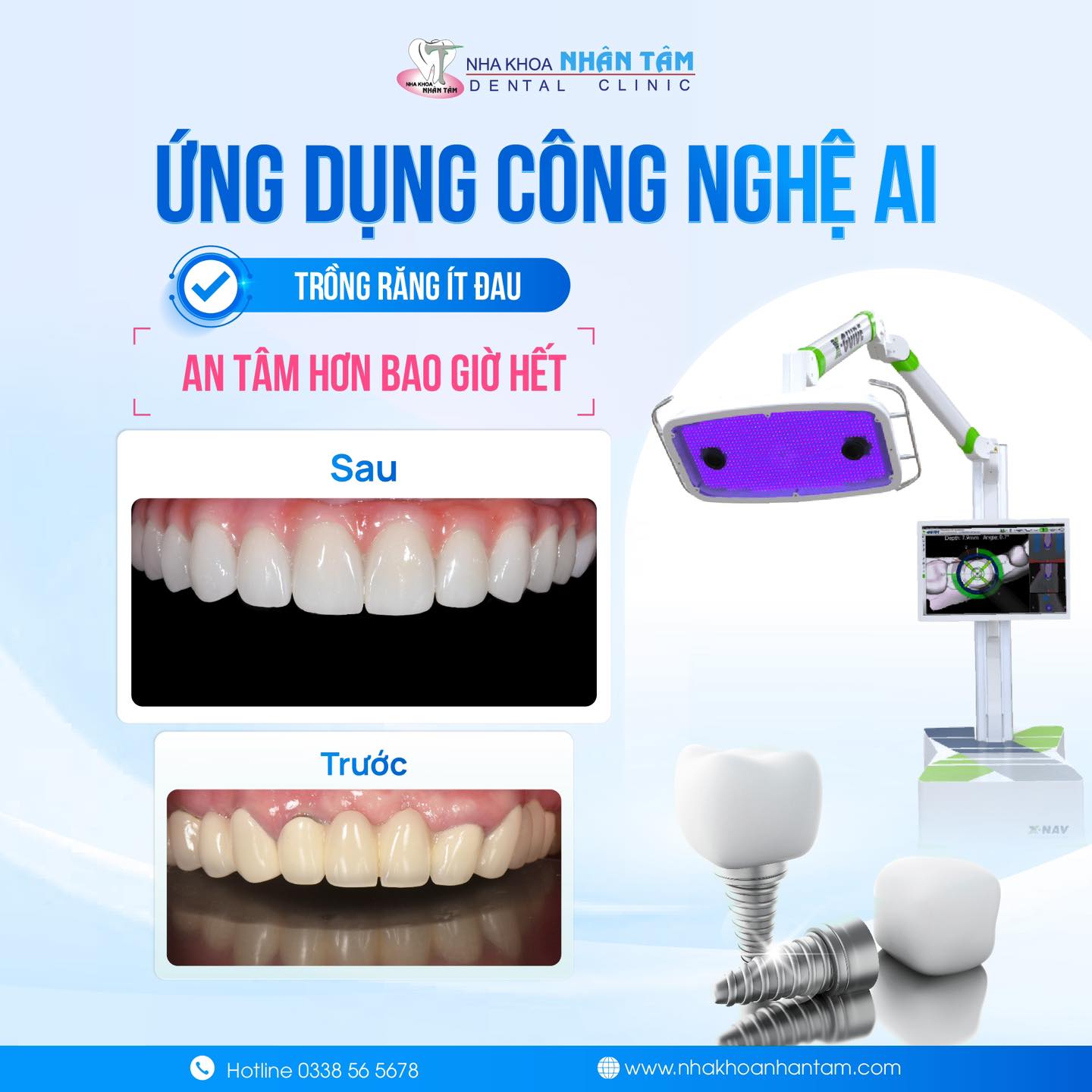 Công nghệ định vị X-Guide giúp quá trình cấy ghép Implant diễn ra thuận lợi, chính xác và an toàn cho khách hàng