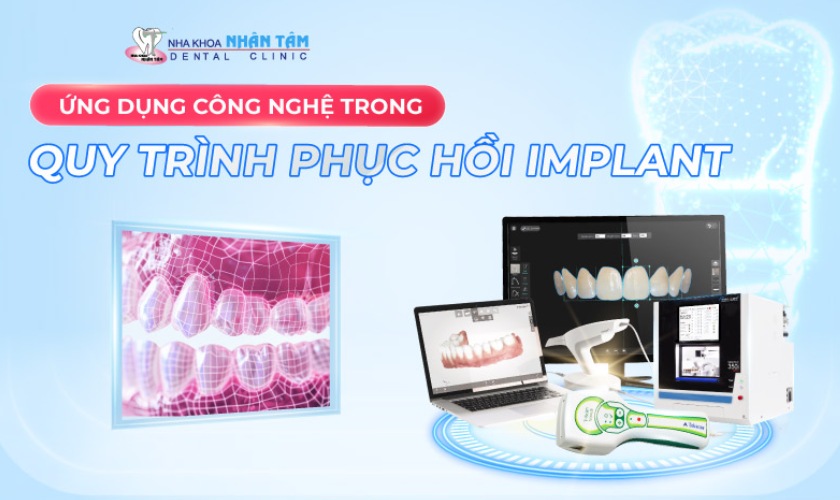AI đóng vai trò quan trọng trong việc phục hồi răng Implant