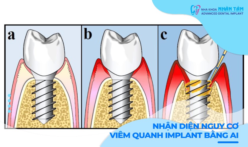 Nhận diện nguy cơ viêm quanh Implant bằng AI