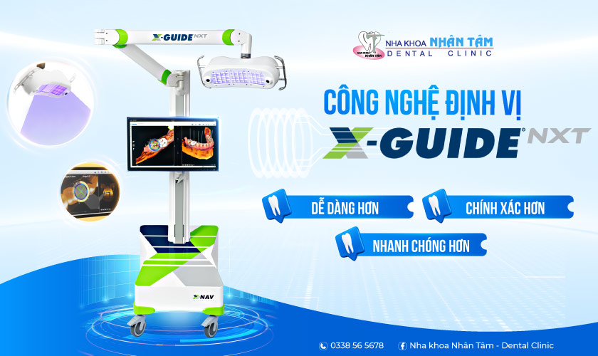 Công nghệ định vị X-Guide hoạt động như một thiết bị GPS trong nha khoa Công nghệ định vị X-Guide hoạt động như một thiết bị GPS trong nha khoa