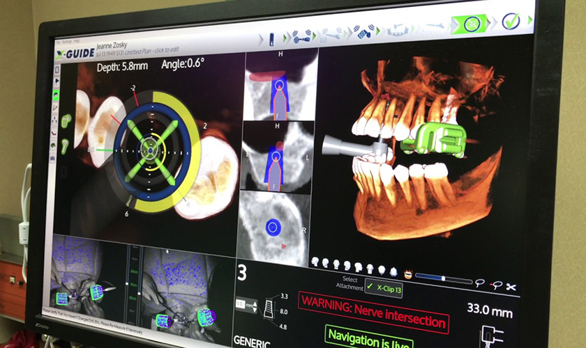 Bác sĩ có thể theo dõi hoạt động của mũi khoan trong xương hàm trên màn hình máy tính Bác sĩ có thể theo dõi hoạt động của mũi khoan trong xương hàm trên màn hình máy tính