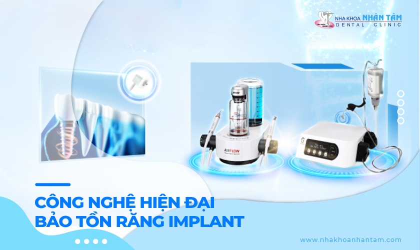 Ứng dụng công nghệ hiện đại trong bảo tồn răng Implant
