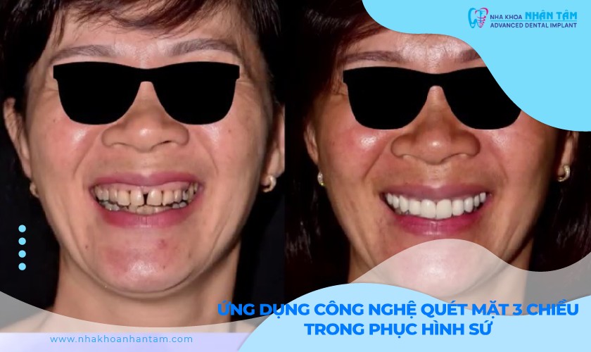 Ứng dụng công nghệ quét mặt 3 chiều trong phục hình sứ