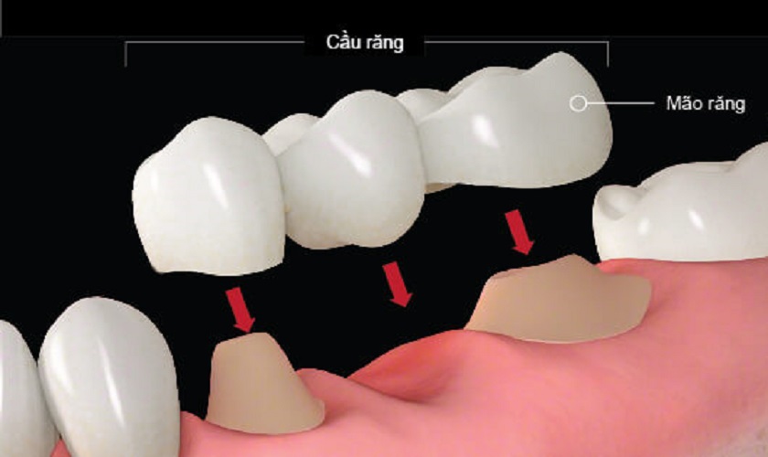 Cầu răng sứ khôi phục răng cấm đã mất