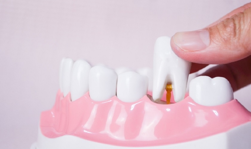 Trồng răng cấm bằng phương pháp nào? Chi phí bao nhiêu?