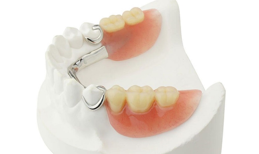 Phục hình răng bằng hàm giả tháo lắp