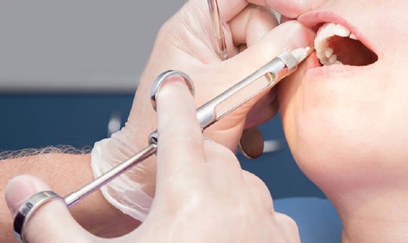 Khách hàng được gây tê trước khi cấy Implant để không cảm thấy đau nhức