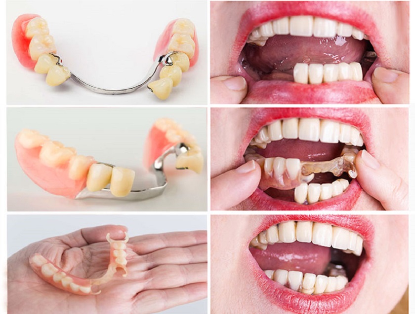 Quá trình phục hình răng bằng hàm giả tháo lắp không gây đau nhức