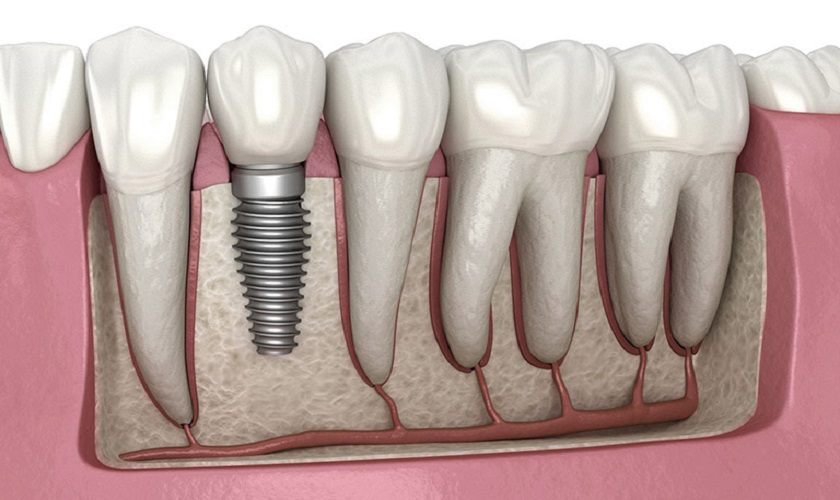Trồng răng hàm bằng Implant nha khoa