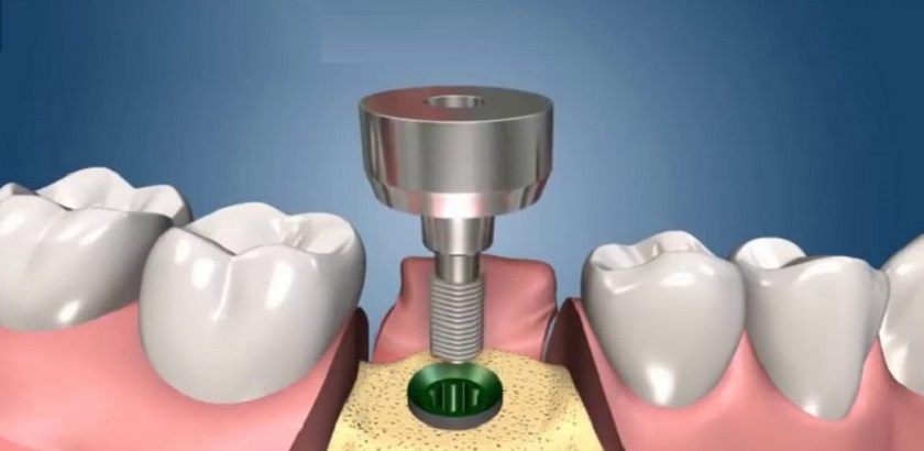 Trong khi trồng răng Implant đau không?